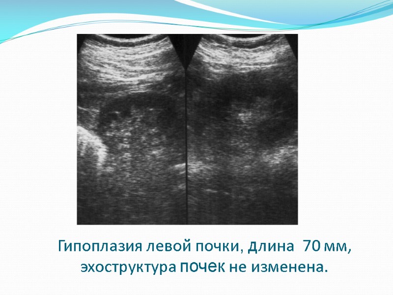 Гипоплазия левой почки, длина  70 мм, эхоструктура почек не изменена.